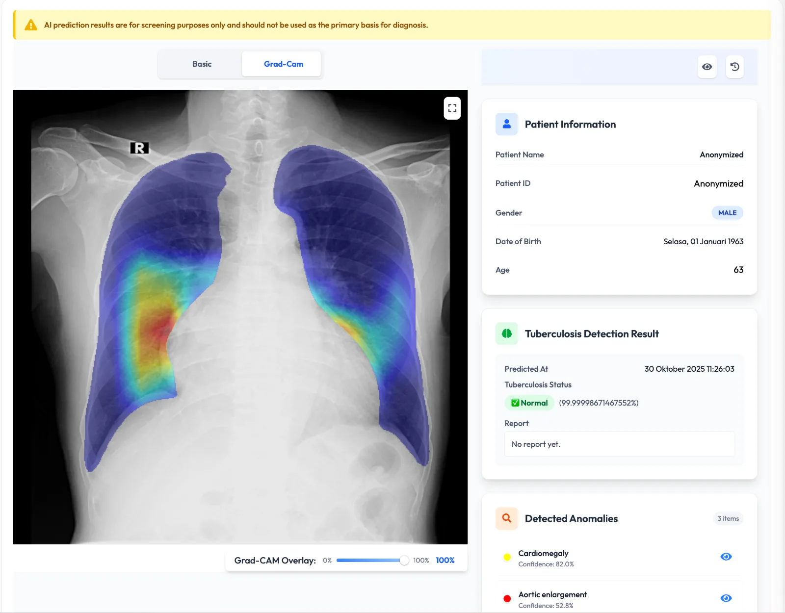 GradCAM heatmap — explainable AI overlay for clinicians
